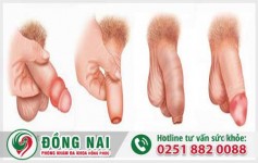 Tìm hiểu chứng sưng dương vật ở nam giới nguyên nhân do đâu?