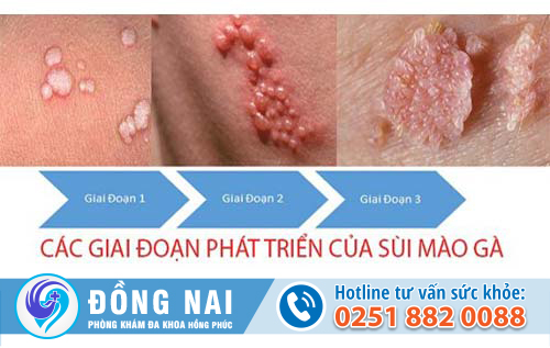 4 căn bệnh tình dục phổ biến và nguy hiểm
