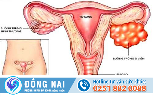 Bạn hiểu biết gì về bệnh viêm buồng trứng