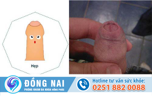 Bao quy đầu bị hẹp có phải là do bẩm sinh không?