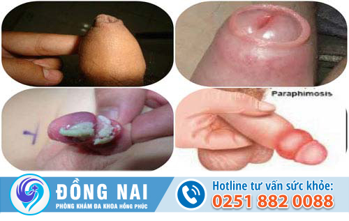 bao-quy-dau-nhu-the-nao-la-dai-lieu-co-gay-nguy-hiem-gi-khong