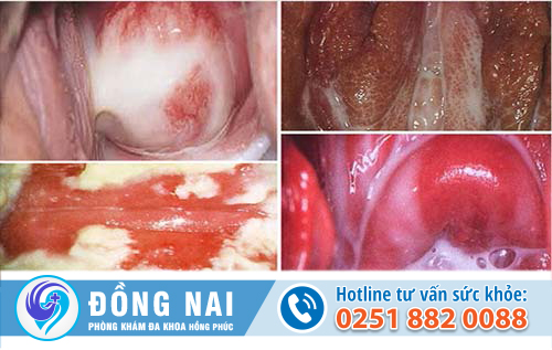 Bốn bệnh phụ khoa thường gặp ở các chị em phụ nữ