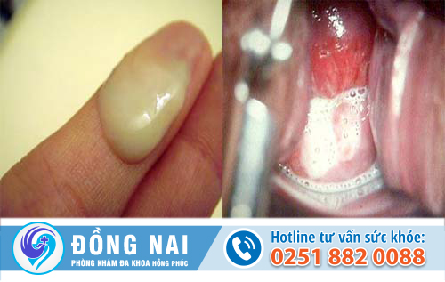 Các biểu hiện của khí hư bất thường