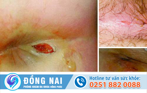 Hậu môn chảy mủ là bị bệnh gì?