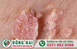 mụn dương vật