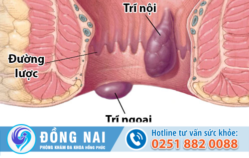 Trĩ hỗn hợp là khi người bệnh mắc cùng lúc trĩ nội và trĩ ngoại