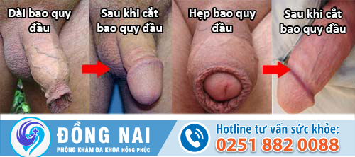 Cắt bao quy đầu có đau không, quy trình thực hiện ra sao?