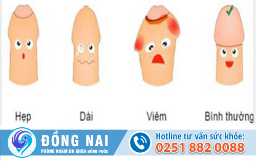 Cắt bao quy đầu ở đâu đồng nai an toàn và giá tốt nhất