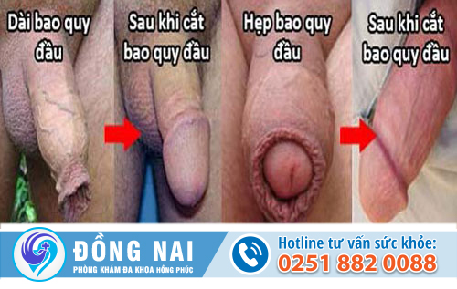 Cắt bao quy đầu nên thực hiện ở đâu cho an toàn?