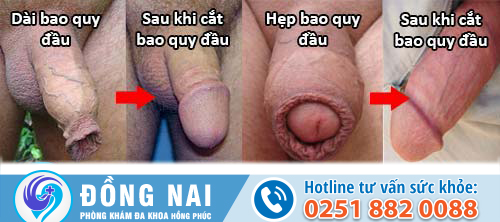 Hẹp bao quy đầu làm dương vật bị ngắn?