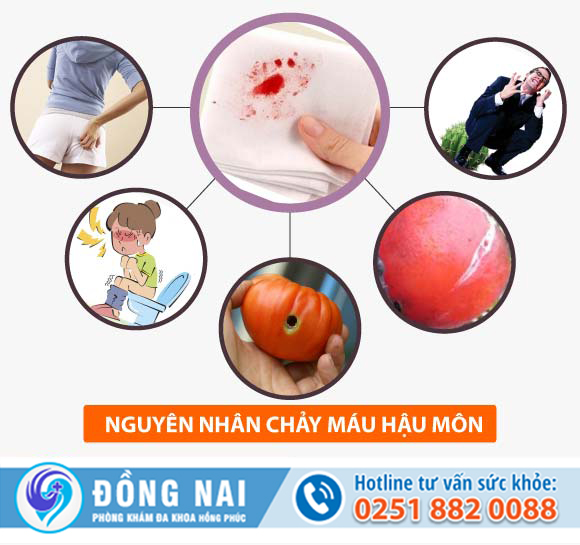 Chảy máu hậu môn là dấu hiệu bị gì?