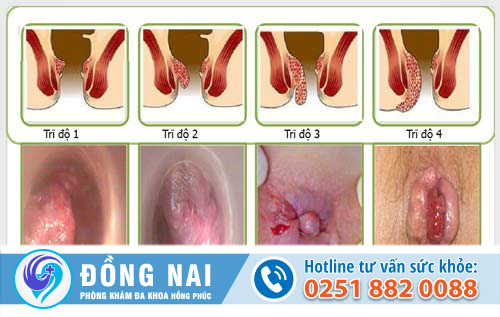 Bệnh trĩ gây chảy máu hậu môn