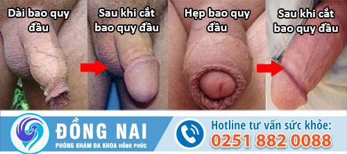 Có nên cắt bao quy đầu hay không?