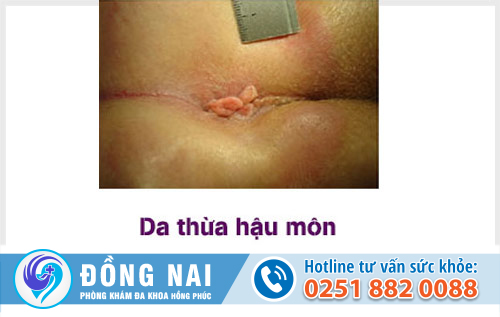 Da thừa hậu môn có tự lành không?