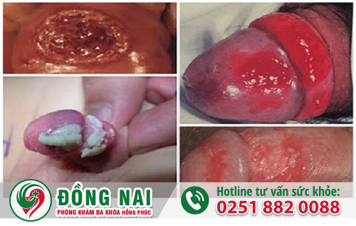 Tình trạng viêm nhiễm do dài bao quy đầu