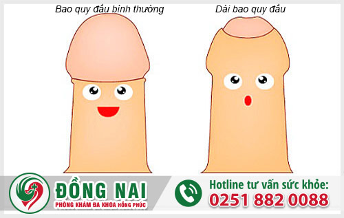 Bốn biểu hiện chính của dài bao quy đầu