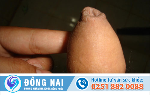 Dài bao quy đầu – Không nên xem nhẹ, cần chữa trị ngay