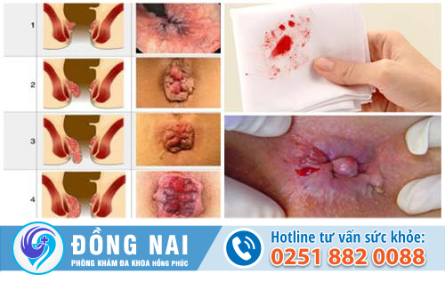 Đau hậu môn là bệnh gì?