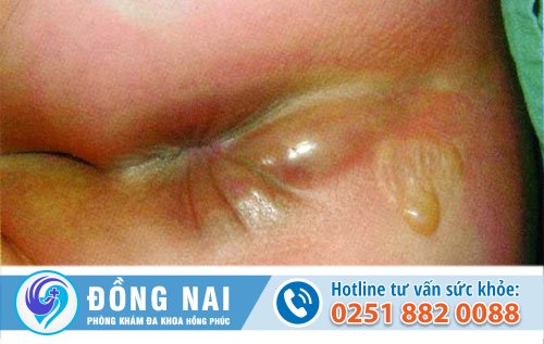 Đau hậu môn là bệnh gì?