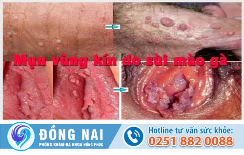 Dấu hiệu mụn vùng kín có thể là bệnh gì?