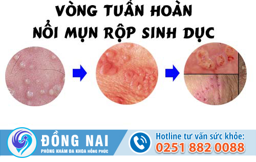 Dấu hiệu mụn vùng kín có thể là bệnh gì?