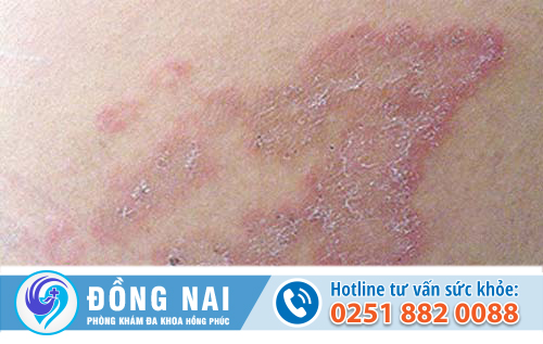 Dấu hiệu nhận biết bệnh chàm hậu môn là gì?