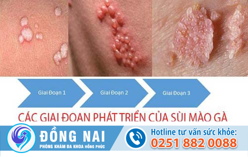 Dấu hiệu và triệu chứng sùi mào gà