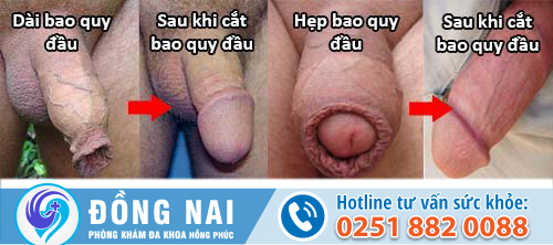 Điều trị dài bao quy đầu ra sao?