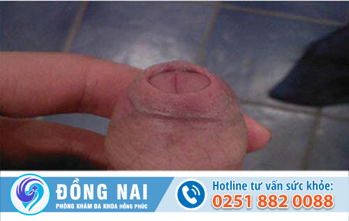 Điều trị hẹp bao quy đầu ở đâu tại Biên Hòa, Đồng Nai