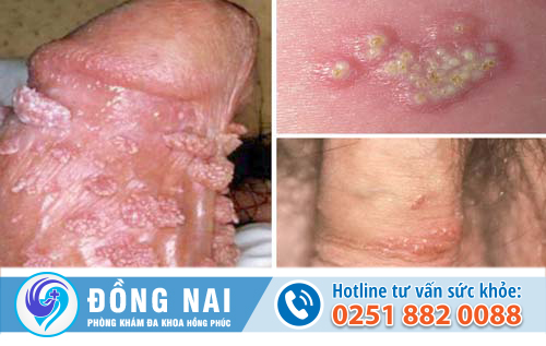 Khi nào thì nam giới bị nổi mụn vùng kín?