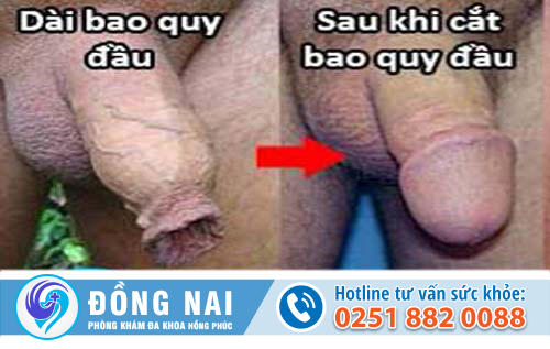 Giải thích hiện tượng dài bao quy đầu và phương pháp điều trị