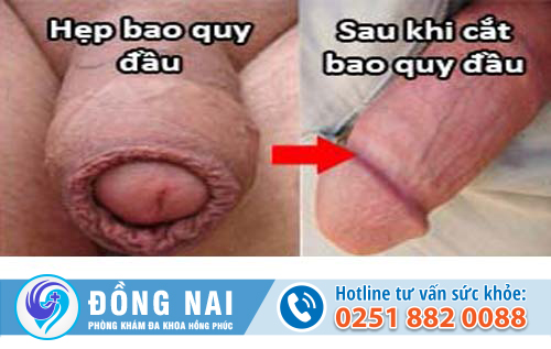 Hẹp bao quy đầu để lâu có nguy hiểm không và cách điều trị ra sao?