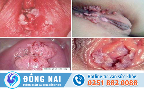 Hình ảnh sùi mào gà giai đoạn đầu ở nữ giới