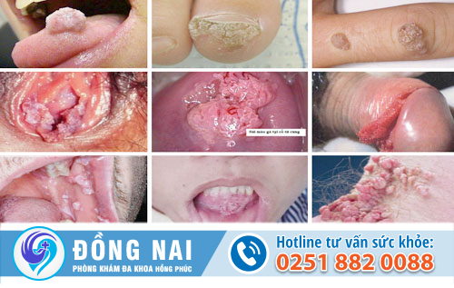 mụn cóc sinh dục