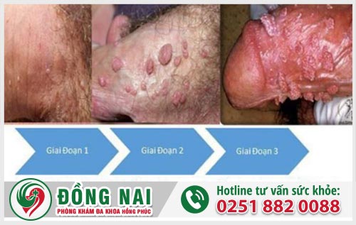 Mụn cơm sinh dục là bị bệnh gì? Có nguy hiểm không?