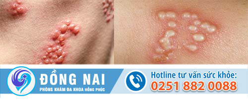 bệnh ở bộ phận sinh dục