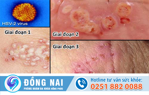 Mụn rộp sinh dục ở nam giới qua 3 giai đoạn