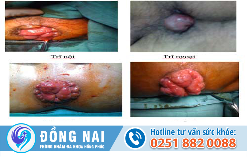 Nguyên nhân gây bệnh sa búi trĩ và cách chữa trị