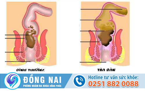 Nguyên nhân táo bón