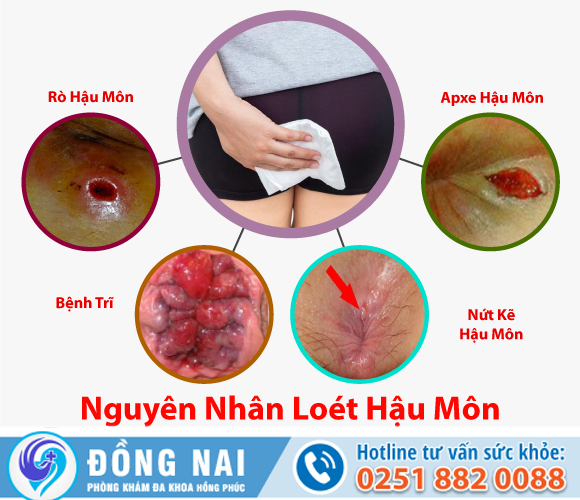 Nguyên nhân và biến chứng loét hậu môn