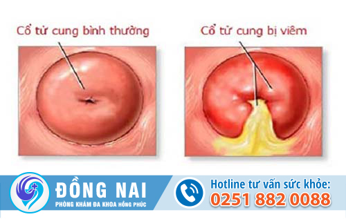 Những dấu hiệu và triệu chứng của bệnh viêm cổ tử cung