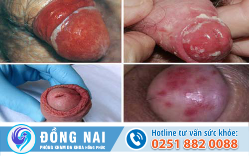 Những triệu chứng bệnh viêm bao quy đầu