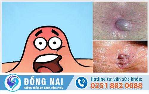 Nổi mụn nhọt ở hậu môn là bệnh gì?
