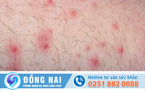 Nổi mụn ở âm đạo của nữ giới