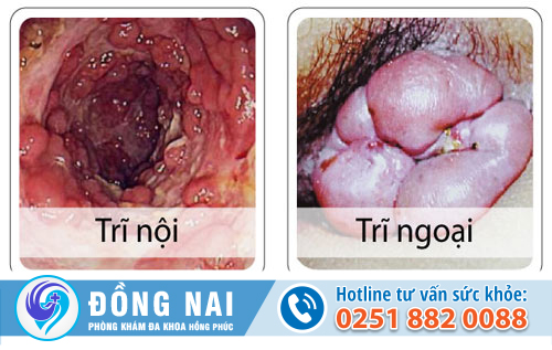 Các loại bệnh trĩ