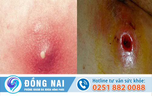 Phương pháp điều trị và cách chữa mụn nhọt hậu môn đạt hiệu quả