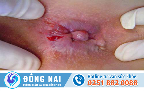 Sa búi trĩ là bệnh gì – Dấu hiệu, nguyên nhân, điều trị ra sao?
