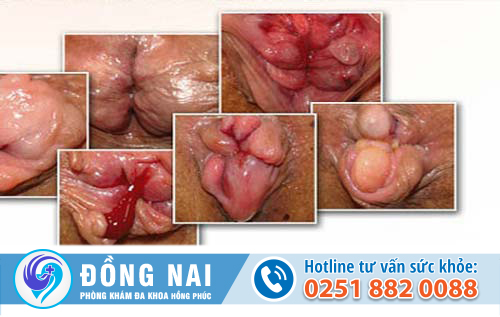 Sa búi trĩ là bệnh gì – Dấu hiệu, nguyên nhân, điều trị ra sao?