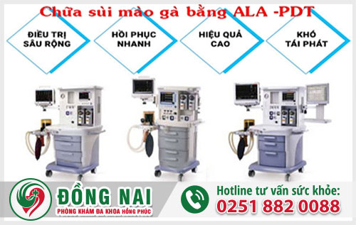 Phương pháp ALA - PDT là phương pháp hiện đại điều trị sùi mào gà đem lại hiệu quả cao