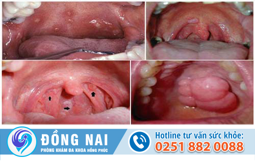 Sùi mào gà ở họng là bệnh gì?